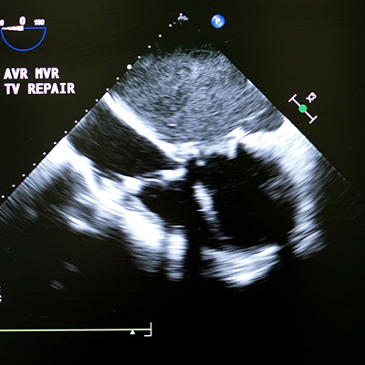 contrast-echo-for-pfo-and-pulm-av-fistulla